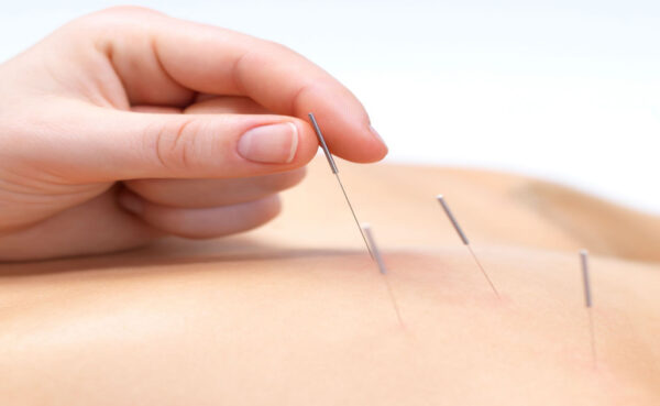 Donate an Acupuncture Treatment